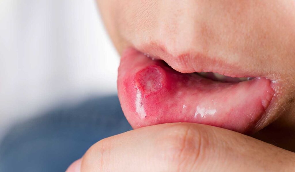 Úlceras aftosas