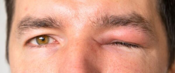 celulitis orbital
