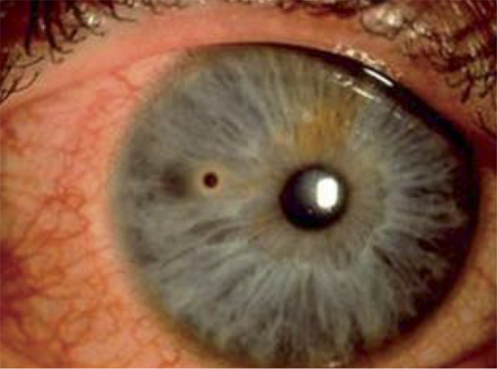 cuerpo extraño intraocular