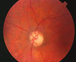 neuropatía óptica isquémica