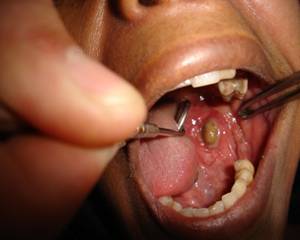 ¿Qué es la sialolitiasis?