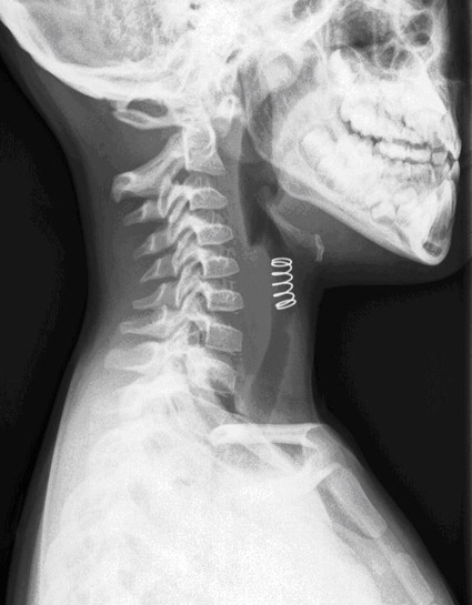 Cuerpos extraños en tráquea y bronquios