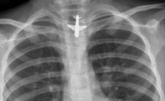 Cuerpos extraños en el esófago