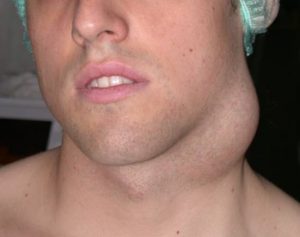 Quistes de la hendidura braquial