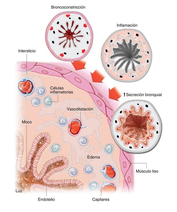 Patogénesis del asma