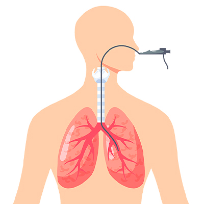Broncoscopía para extracción de cuerpos extraños