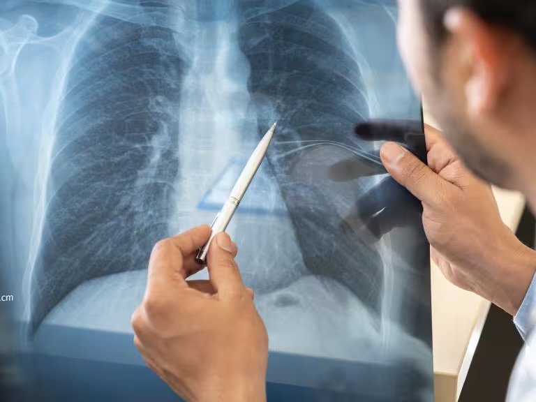 Manifestaciones clínicas de la enfermedad pulmonar obstructiva crónica