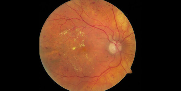 Prevención y factores de riesgo de la retinopatía diabética