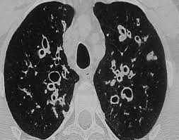 Causas de Bronquiectasia