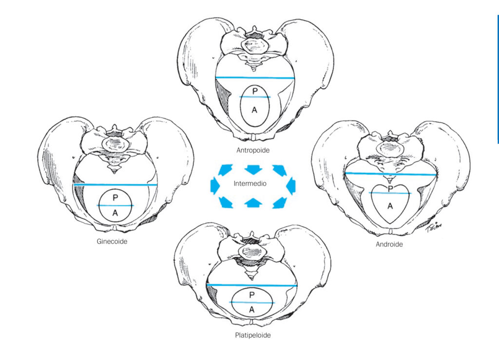 Clasificación anatómica de la pelvis Caldwell-Moloy