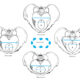 Clasificación anatómica de la pelvis Caldwell-Moloy