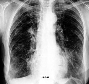 Aspergillosis Broncopulmonar Alérgica