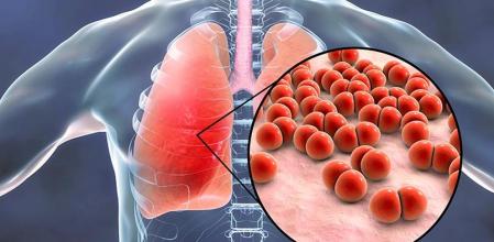 Etiología de Neumonía adquirida en la comunidad