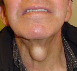 Quistes del conducto tirogloso