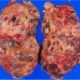 Enfermedad renal poliquística autosómica dominante