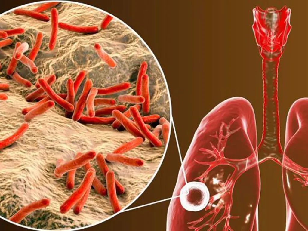 Tratamiento de la tuberculosis latente