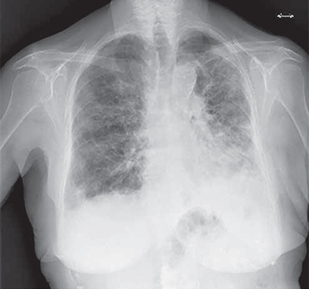 Enfermedad Pulmonar Intersticial