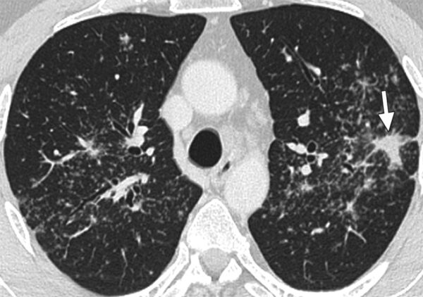 Sarcoidosis pulmonar