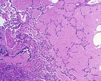 Proteinosis alveolar pulmonar