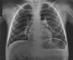 Síndromes pulmonares eosinofílicos