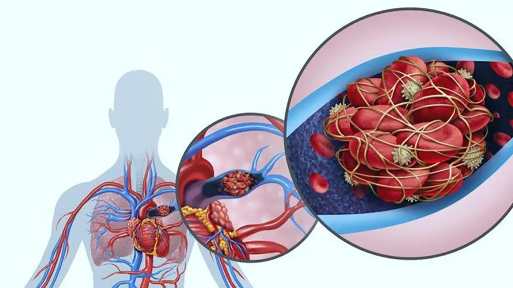 Diagnóstico y predicción de riesgo de la embolia pulmonar