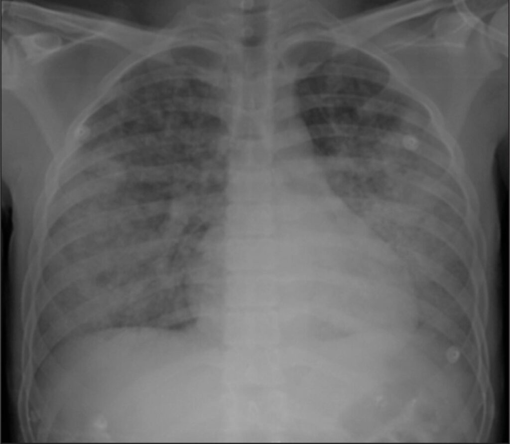 Síndromes de hemorragia alveolar