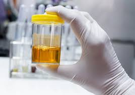 Determinación urinaria de electrolitos