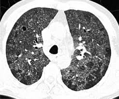Neumonitis por hipersensibilidad