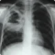 Neumonía Anaeróbica y Absceso Pulmonar