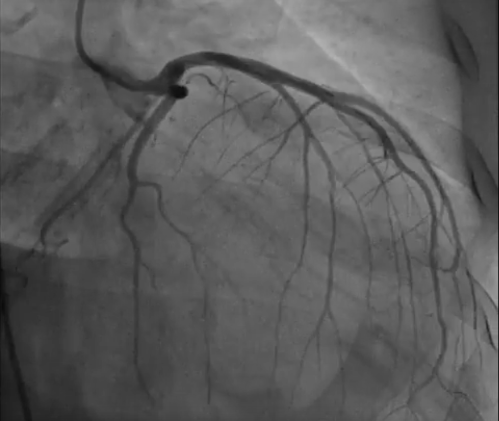 Angiografía coronaria en pacientes con infarto agudo de miocardio con elevación del segmento ST.