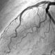 Arteriografía coronaria en paciente con angina de pecho crónica estable