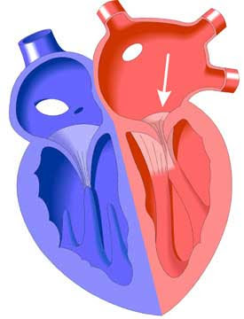 Estenosis mitral