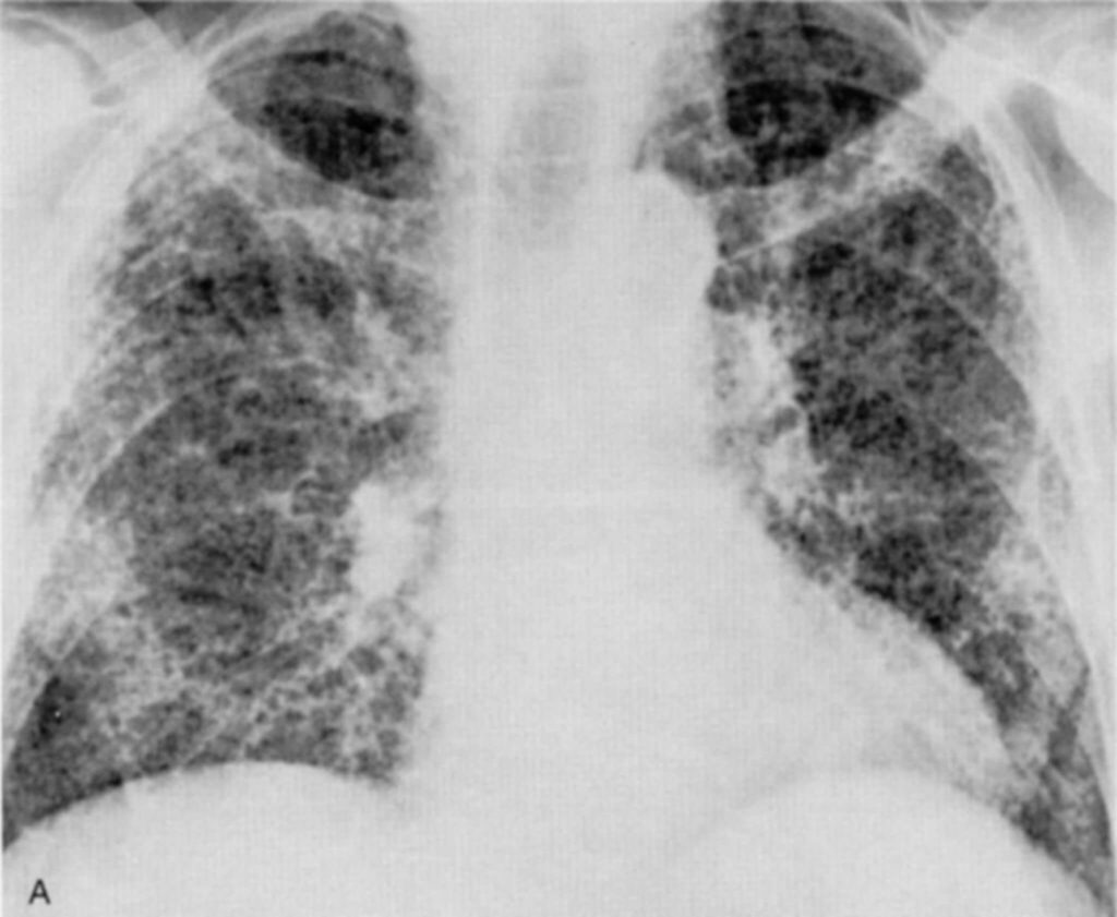 Fibrosis pulmonar por radiación