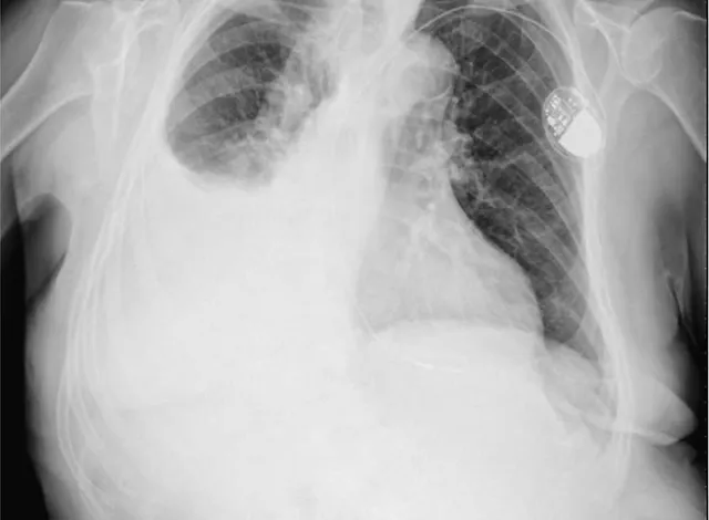 Derrame pleural