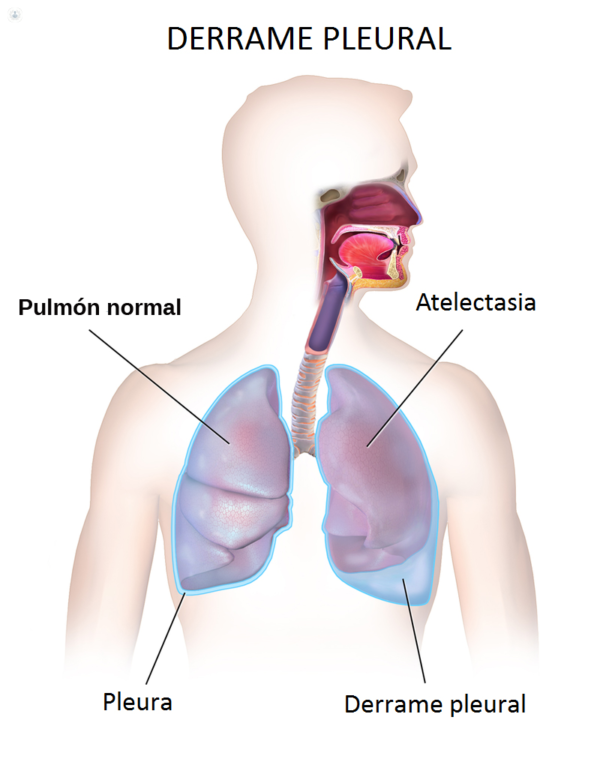Tratamiento de los derrames pleurales