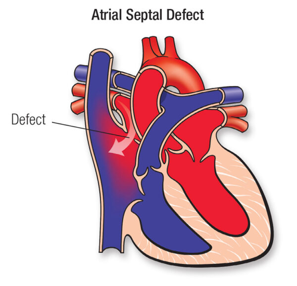 Defecto del septo atrial y foramen oval permeable