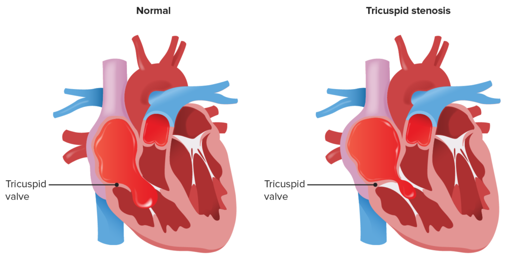 Estenosis tricuspídea
