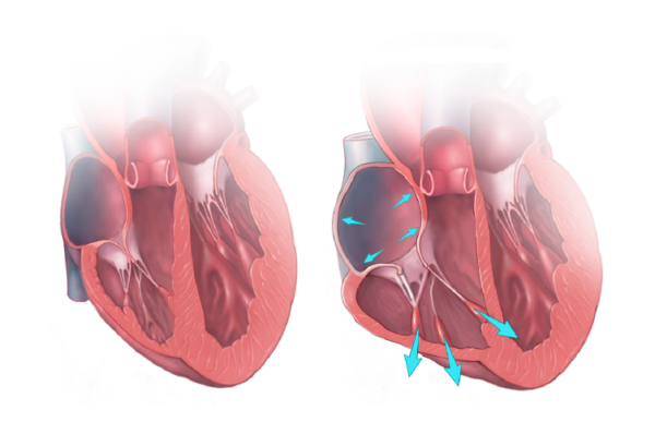 Regurgitación valvular tricúspidea