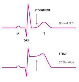 Características clínicas del infarto agudo de miocardio con elevación del segmento ST