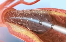 Intervención coronaria percutánea primaria