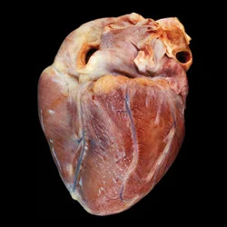 Tumores cardíacos secundarios