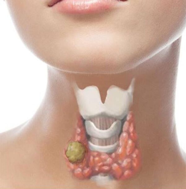 Tratamiento de Nódulos Tiroideos Solitarios Tóxicos