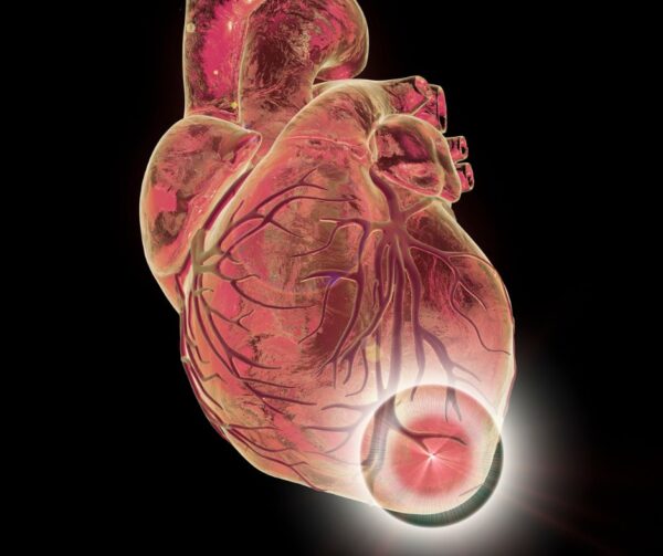 Isquemia post infarto