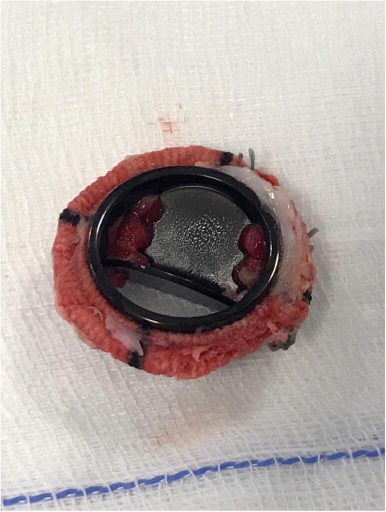 MANEJO DE LA ANTICOAGULACIÓN PARA PACIENTES CON VÁLVULAS CARDÍACAS PRÓTESICAS