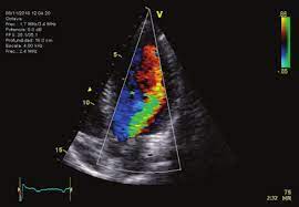 Manifestaciones clínicas de regurgitación aórtica