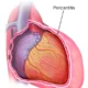 Pericarditis constrictiva