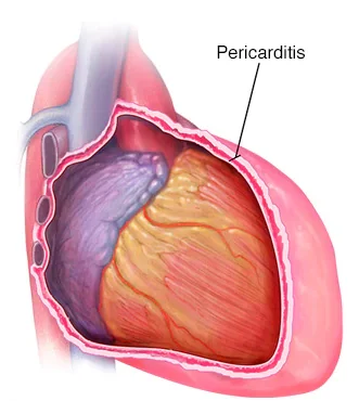 Pericarditis constrictiva