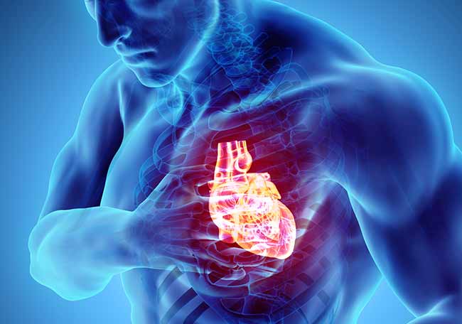 Síntomas de la angina de pecho crónica estable