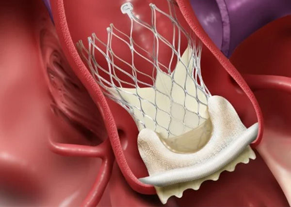 Tratamiento de la estenosis aórtica
