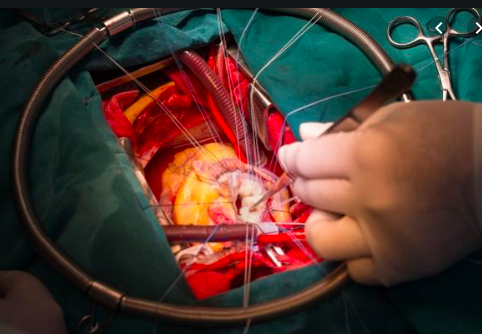 Tratamiento de la regurgitación mitral primaria